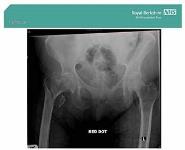 Hip Fracture PowerPoint Presentation