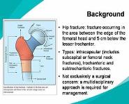 About Hip fracture PowerPoint Presentation
