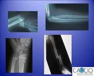 The A B Cs of Playground Bone and Joint Injuries PowerPoint Presentation