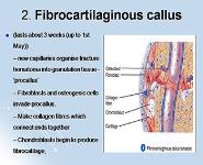 Fractures and Bone Healing PowerPoint Presentation