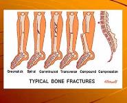How are sports injuries classified and managed PowerPoint Presentation