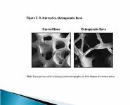 OSTEOPOROSIS An update PowerPoint Presentation