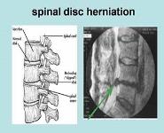 Disorders and Abnormal Curvatures of Spinal Column PowerPoint Presentation