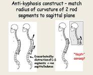 Kyphosis and Early-Onset Spine Deformity PowerPoint Presentation