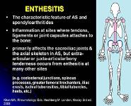 Seronegative Spondyloarthritides PowerPoint Presentation