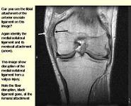 Knee injury PowerPoint Presentation