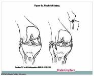 Prevention and Rehabilitation for ACL injuries PowerPoint Presentation