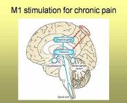 Neuromodulation for chronic pain PowerPoint Presentation