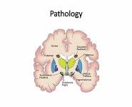 Idiopathic parkinsons disease (IPD) PowerPoint Presentation
