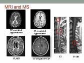 New TRENDS IN Multiple Sclerosis Epidemiology