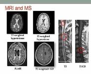 New TRENDS IN Multiple Sclerosis Epidemiology PowerPoint Presentation