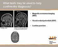 Multiple Sclerosis-What You Need to Know About the Disease PowerPoint Presentation