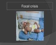 Les Convulsions Neonatales PowerPoint Presentation