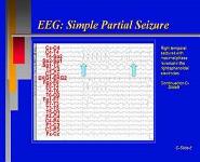 Clinical Epilepsy PowerPoint Presentation Notes