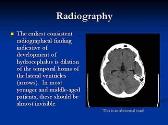 Hydrocephalus