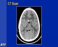 Management of Severe Traumatic Brain Injury PowerPoint Presentation