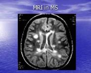 DEMYELINATING DISEASE MULTIPLE SCLEROSIS PowerPoint Presentation