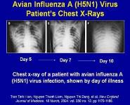 Case Management of Suspect Avian Influenza A (H5N1) Virus Infection in Humans PowerPoint Presentation