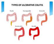 Ulcerative Colitis PowerPoint Presentation