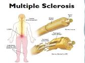 Multiple Sclerosis