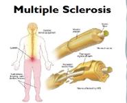 Multiple Sclerosis Medical Notes