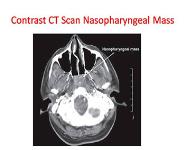 TUMORS OF NASOPHARYNX PowerPoint Presentation