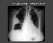 Pulmonary Embolism PowerPoint Presentation