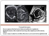 Diagnosis of Fetal Malformation By Ultrasound