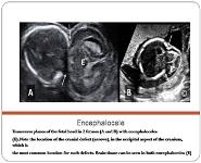 Diagnosis of Fetal Malformation By Ultrasound PowerPoint Presentation