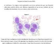 Leucemies Aigues Medical Notes