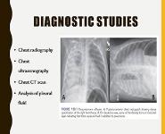 PLEURAL EFFUSION PowerPoint Presentation