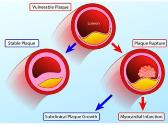 Acute Coronary Syndromes
