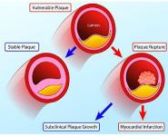 Acute Coronary Syndromes PowerPoint Presentation