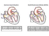 Wolf Parkinson White Syndrome