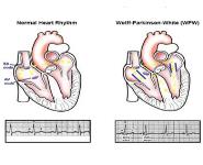 Wolf Parkinson White Syndrome Medical Notes