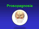 Prosopagnosia