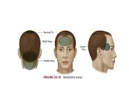 Headache PowerPoint Presentation