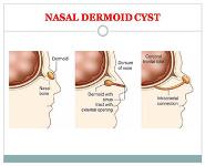Tumours of Nose and PNS PowerPoint Presentation