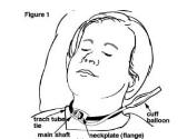 Tracheostomy Care