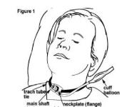Tracheostomy Care Medical Notes