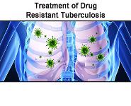 Treatment of Drug-Resistant Tuberculosis PowerPoint Presentation