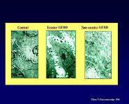 GERD and Complications PowerPoint Presentation