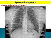 Radiology Chest X-ray-Systematic Approach