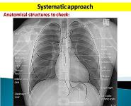 Radiology Chest X-ray-Systematic Approach PowerPoint Presentation