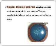 Cataract PowerPoint Presentation