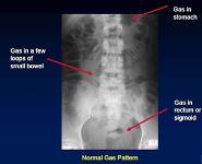 Acute Abdomen PowerPoint Presentation