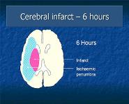 Thrombolysis Nursing Competencies PowerPoint Presentation Notes
