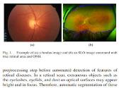 Diagnosing Retinal Diseases