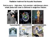 Acoustic Neurinoma Cyberknife Radiosurgery