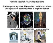 Acoustic Neurinoma Cyberknife Radiosurgery PowerPoint Presentation